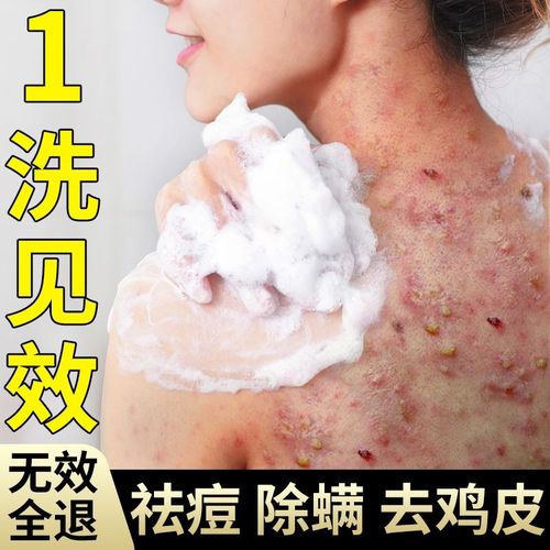穿婚纱背上有痘印怎么快速祛除